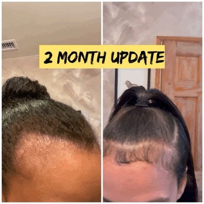 Hair Growth Liquid Oil with Amla, Fenugreek & Neem - 2 Month Before/After