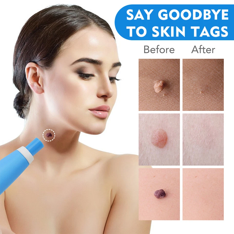 Auto Micro Skin Tag Remover Pen Device Kit Safe Painless Removal Skin Care Tool - Image 2 of 4