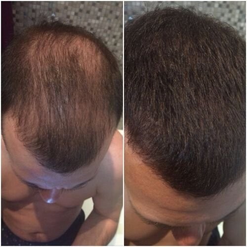 Derma Roller W/ Case For Hair Loss And Fast Beard Growth Titanium ✅Top Quality✅ - Picture 2 of 7