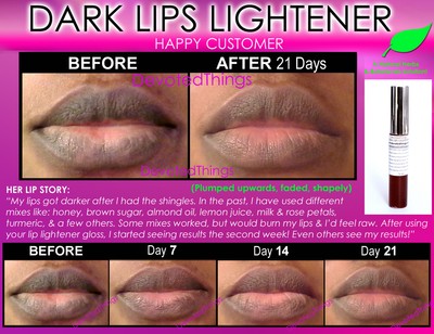 11+ Before and After Best Lip Lightening Bleach Bleaching ...