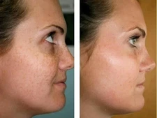 KOJIC ACID Skin Whitening Lightening Brightening Serum Bleaching/Spot Fade 30ml