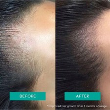 Intensive Hair Growth Serum - 3 Redensyl, 3 Procapil  Derma Tested 30ml