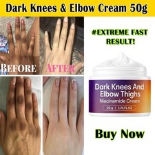 Best Strong Whitening Cream For Removing Dark Knuckle Finger Elbow and Knee