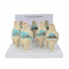 Osteoarthritis Knee Model Educational for Medical Students