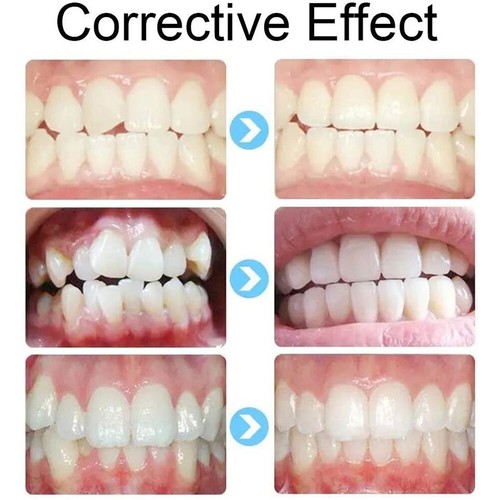 Dental Orthodontic Invisible Retainer Brace Appliance Alignment Trainer 3 Stages - Imagen 8 de 15