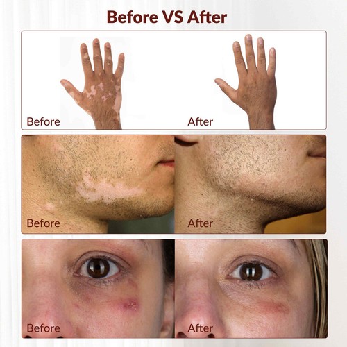 308nm Ultraviolet Light Treatment for Skin Health UVB Lamps Phototherapy Device - Picture 6 of 15
