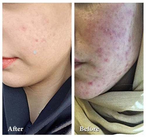 Demodexcillin Skin Solution 4 Fl.Oz Recommended For Acne, Rosacea, Blepharitis - Picture 6 of 14