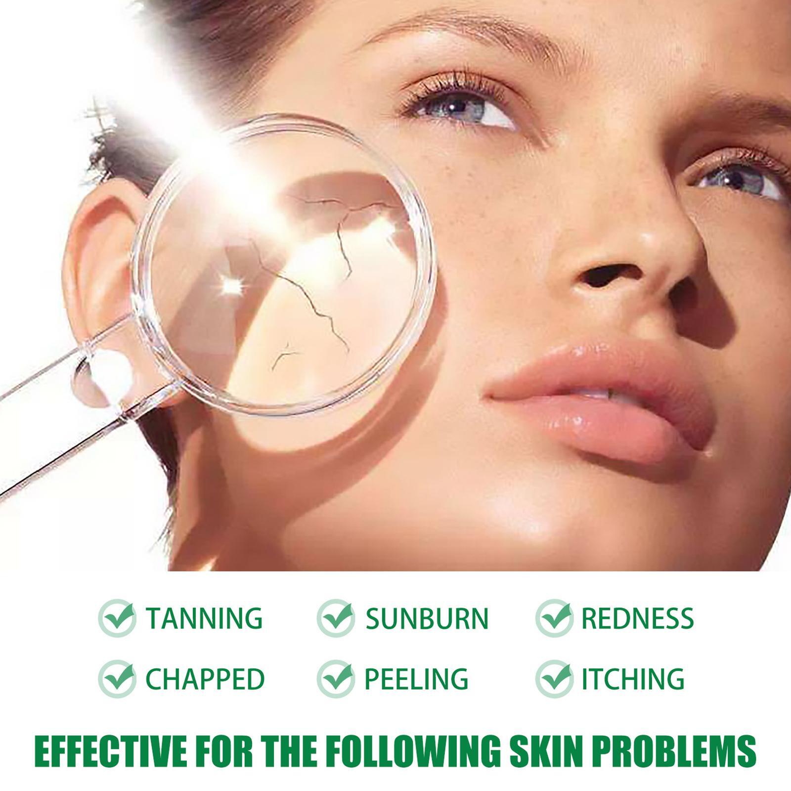 aloe for face sunburn