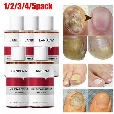 5/3 x Nail Repair Essence Remove Onychomycosis Serum Fungal Nail Treatment Oil