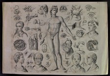 - Henry WINKLES (1801-1860) Stahlstich - CHIRURGIE Anatomie - Operationen Tafel