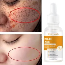 Kojic Acid Dark Spot Corrector Serum Whitening Freckle Melasma Fade