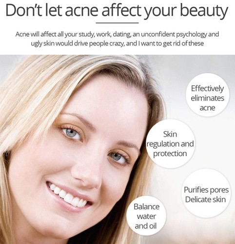 AICHUN BEAUTY Anti-Acné Blanqueador Suero Facial Extracto de Aloe Vera Ácido Salicílico - Imagen 5 de 10