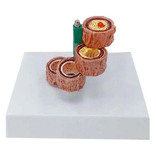 Blood Vessel Anatomy Model Arteries Atherosclerosis Thrombosis Vascular Disease