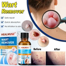 Wart Remover Liquid Skin Tag Mole Remover Eliminate Feet Corn Wart Removal 30ml