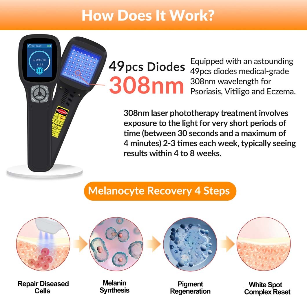 308nm Excimer Laser Treatment Device Handheld UVB for Skin