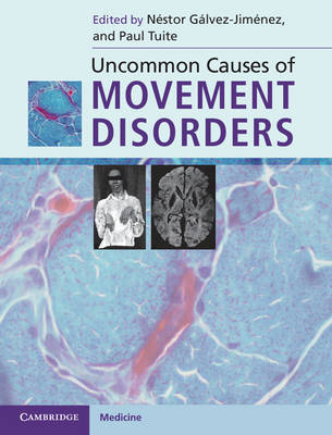 Uncommon Causes of Movement Disorders Gálvez-Jiménez Tuite Hardback