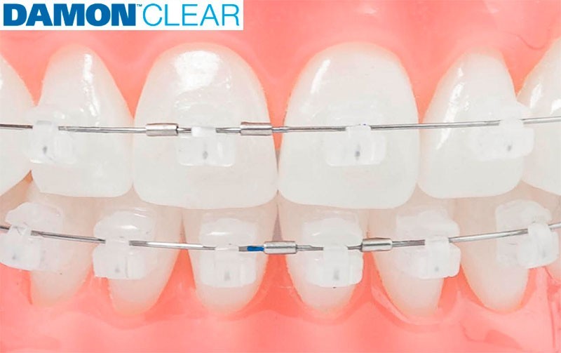 Damon Clear 2 & Q2 Hybrid Orthodontic Bracket Set – Lot of 5 Cases