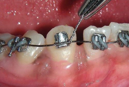 Orthodontic Stainless Steel CrNi Ligature Wire Spool .25mm /.010" Roll of 130m | eBay