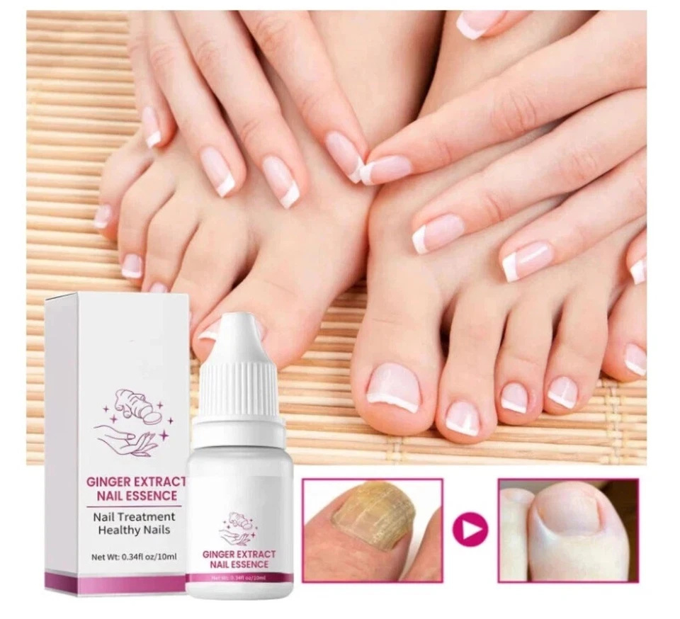Tratamiento de uñas FungiGone de 1 ~ 5 piezas, solución para uñas de dedo del pie extra fuerte para cuidado de uñas hongos Foto 3 de 4