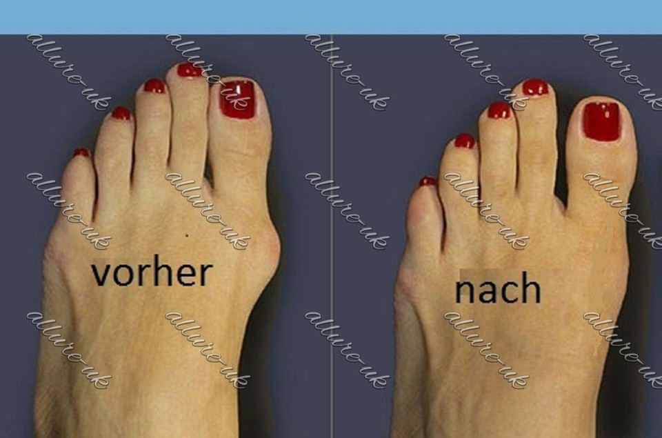 Bandage 2 Stück Schiene Zehenkorrektur Medicus Pro Hallux Valgus