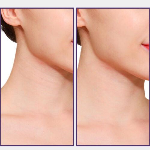 20Pcs Neck Lift Adhesive Strips Neck Tape Thin Face Rubber Miss Face Lift Tape - Picture 7 of 9