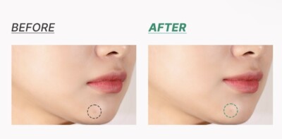 ACNE Spot Patches Pimple Patch Teatree