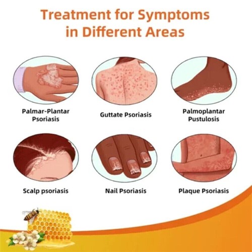 BeeVenom Psoriasis Treatment-Cream Dermatitis Eczema Mild Healing Antibacterial - Picture 4 of 14