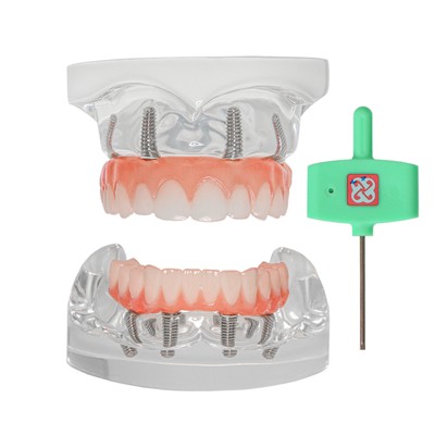 US Dental 4 Implants Upper+Lower Demo Teeth Model Restoration Overdenture