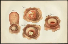 Vintage Medical Illustration GYN Female Disease cervix lithograph print c1900