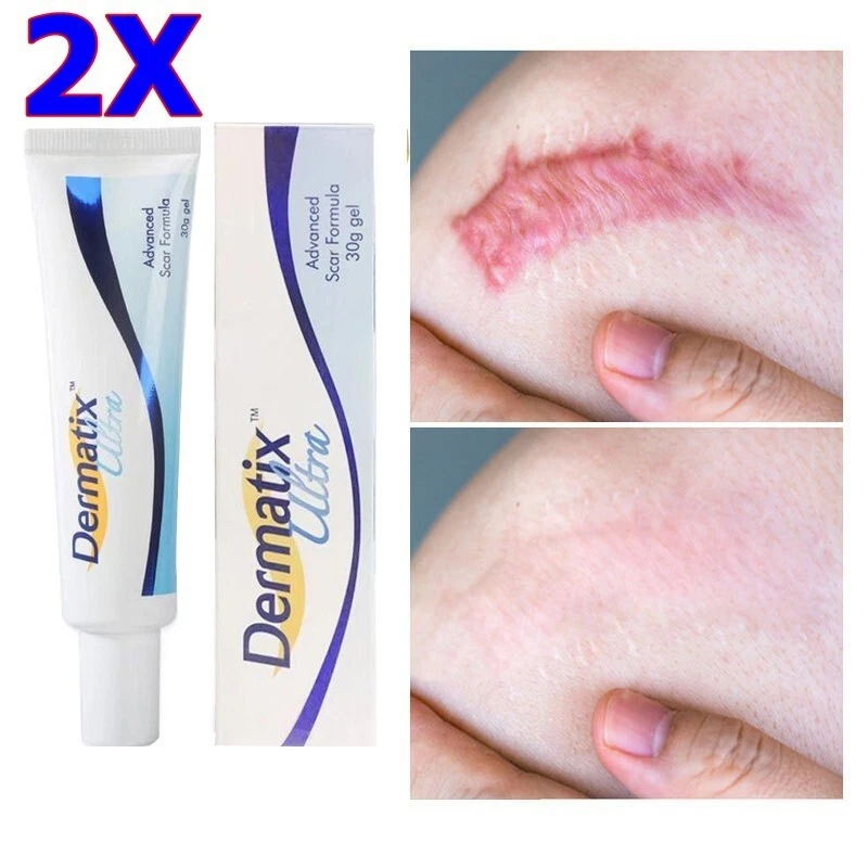 Dermatix on sale scar gel