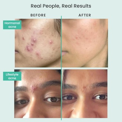 Solved Skin Acne Fash Wash Cleanser Benzoyl Peroxide Kills Acne Bacteria - 100ml