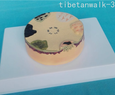 Human Skin Cancer Pathology Enlarged Anatomical Model Teaching Model 