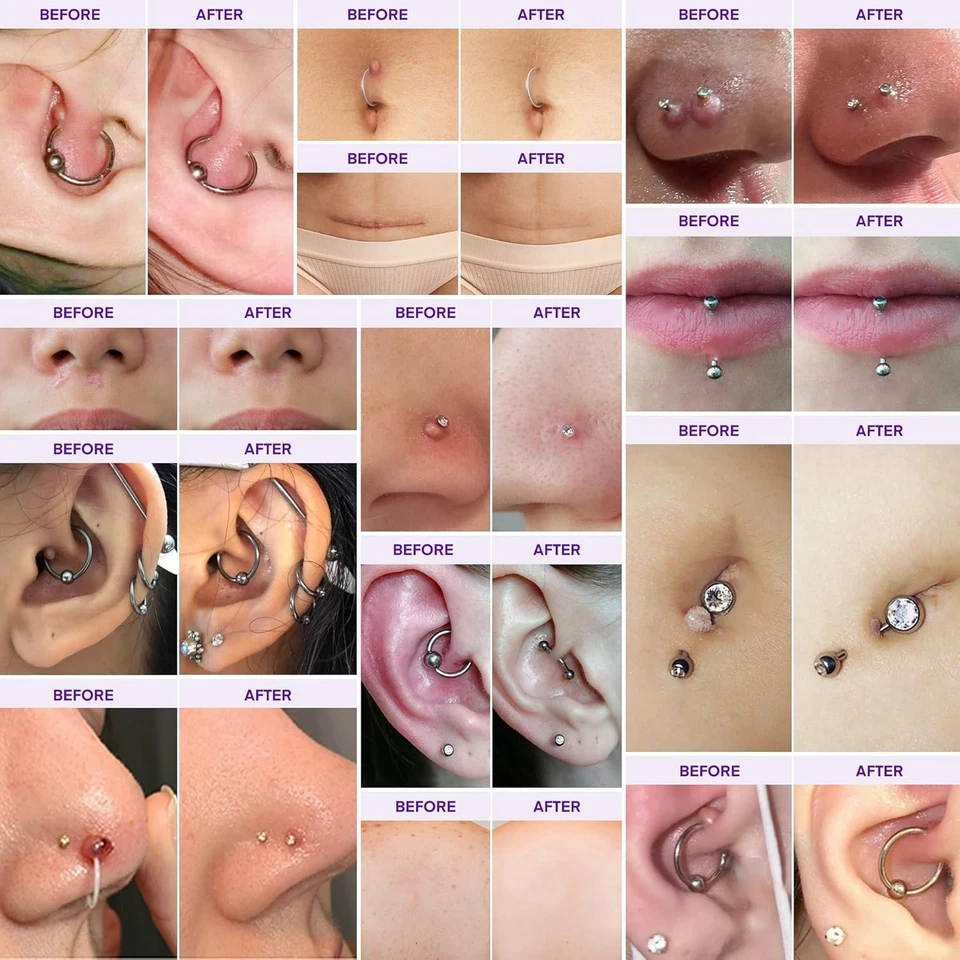 Kit de eliminación de piercing y queloides - Aceite de cuidado posterior + Tratamiento de gel curativo Foto 3 de 4