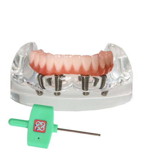 US Dental All-on-4 Overdenture Implant Model, Upper/Lower Jaw-Clear,With 4 Screw - Picture 22 of 51