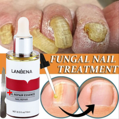LANBENA Nail Repair Essence Remove Onychomycosis Serum Fungal Nail Treatment