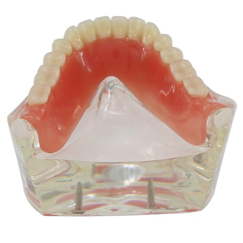 Demo modello denti Typodont restauro overdenture dentale con 2 impianti modello - Foto 10 di 12