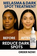 Melasma Corrector Serum   Dark Spot Remover   Extra Strength Skin Lightener
