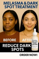 Melasma Corrector Serum – Dark Spot Remover – Extra Strength Skin Lightener