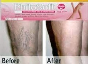stretch marks on legs cream