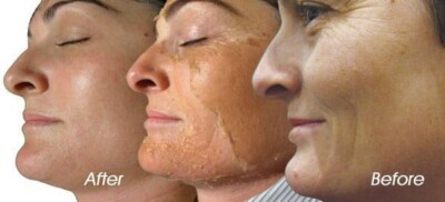Resurfacing Chemical Peel 90% Acid Concentrated Formula MUST DILUTE Niacinamide