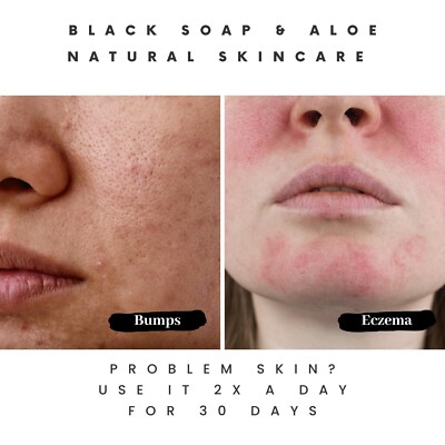 Pimple Soap: A Solution for Acne and Hyperpigmentation