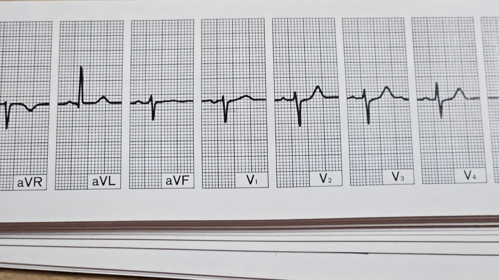 Vintage MERCK SHARP &DOHME THE ELECTROCARDIO GUIDE REPRESENTATIVE ECG CONDITIONS