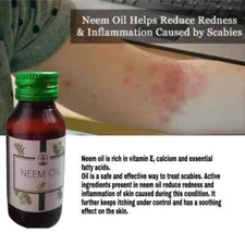 ANTI SCABIES KILLS SCABIES MITES AND EGGS COMPLETE ERADICATION OIL 1 BOTTLE PACK