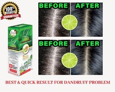 ANTI DANDRUFF SHAMPOO - HERBAL BLOOM - ALL TYPE HAIR - FAST RESULTS