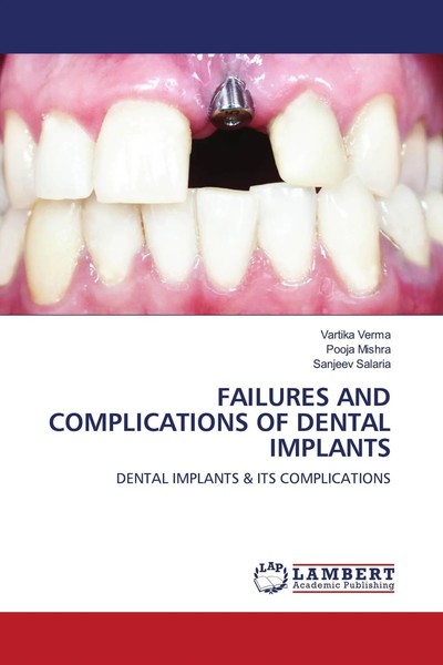 Failures AND Complications OF Dental Implants Vartika Verma (U. A.) Taschenbuch-image