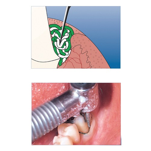 3x Dental Zahnfleisch Retraktion DS-CORD Twist Imprägniert Adrenalin Grün - Bild 5 von 5