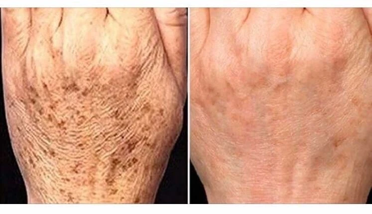 Super Skin Lightener Cream, Eliminan Las Manchas Oscuras Para Piel Clara, 5 oz. - Image 4 of 4