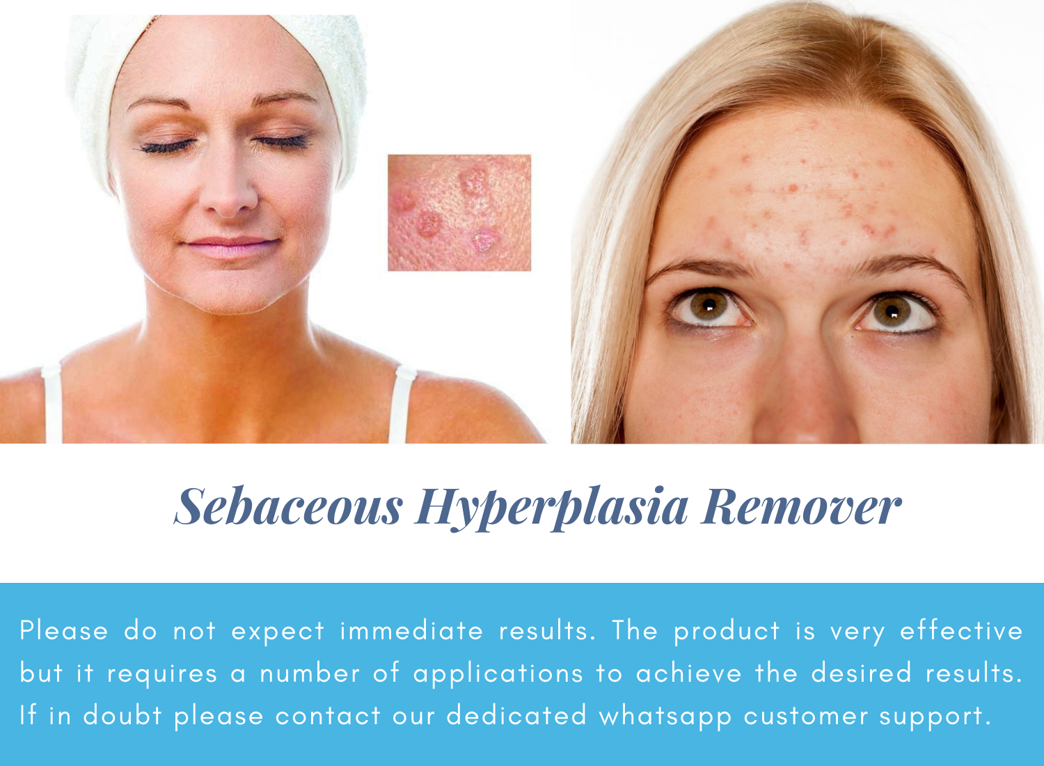 Sebaceous Hyperplasia Removal & Professional Glycolic Acid skin peel at ...