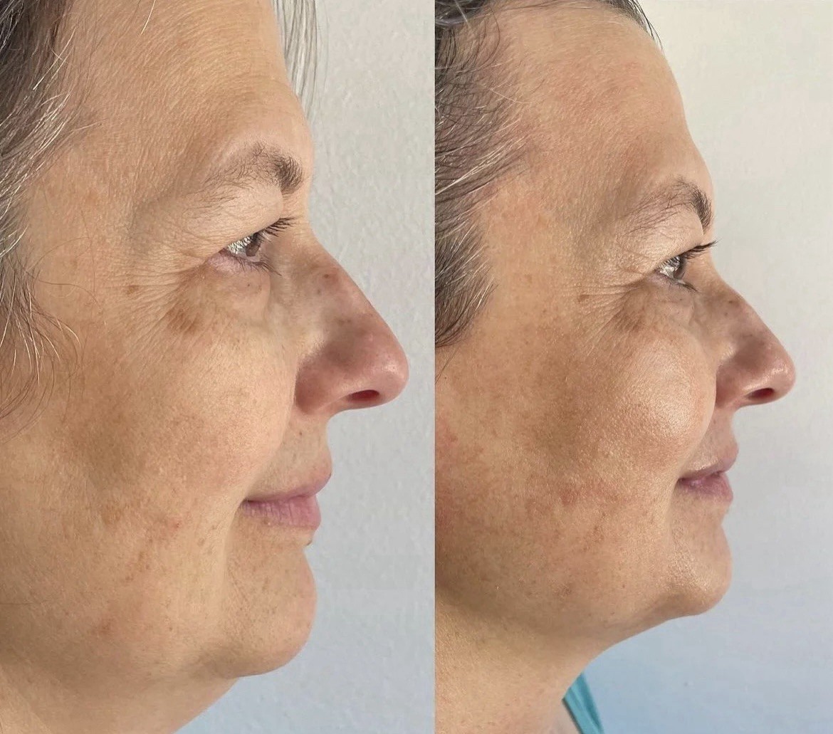 KrX V Tox Lift Mask | eBay