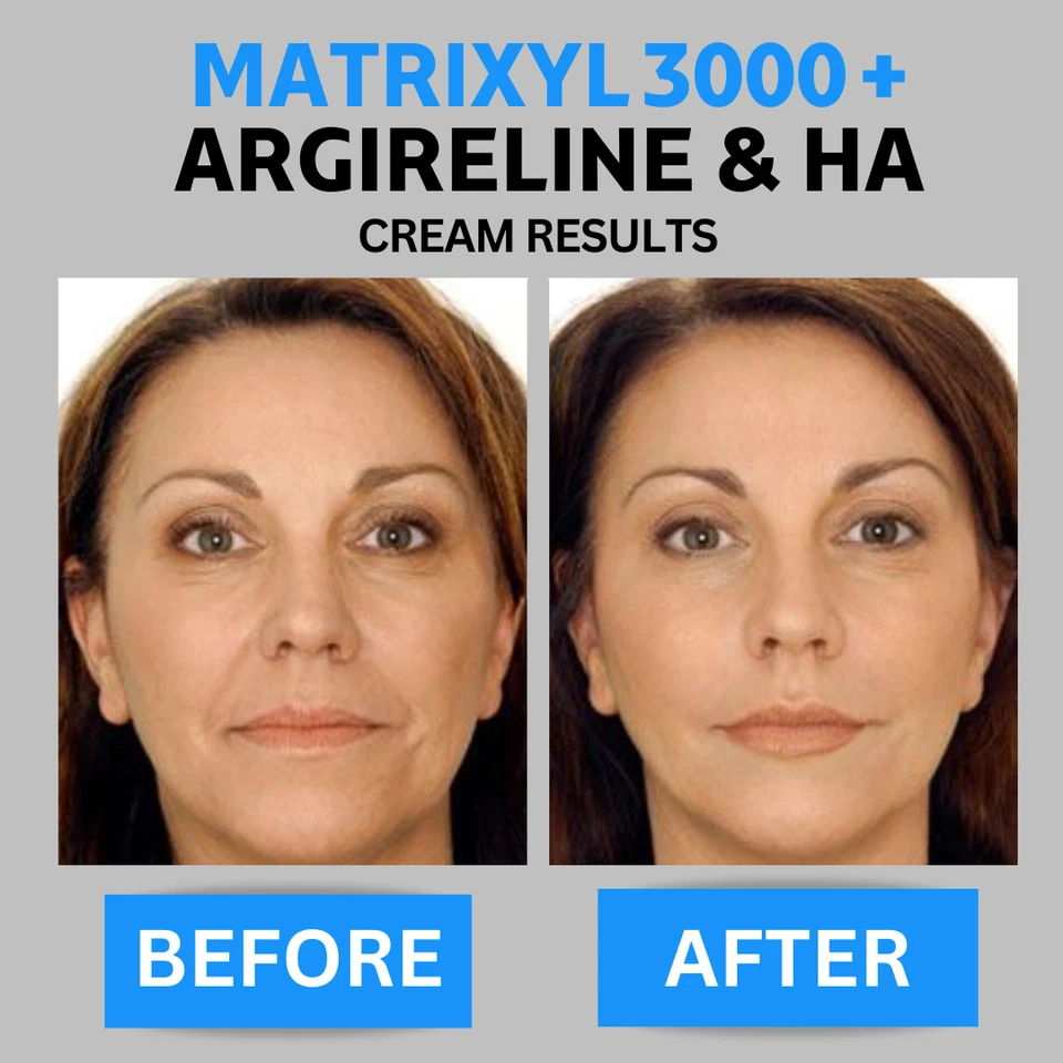 2 Pk - Matrixyl 3000, Argireline Hyaluronic Acid AntiAging Wrinkle SERUM + CREAM - Image 2 of 4